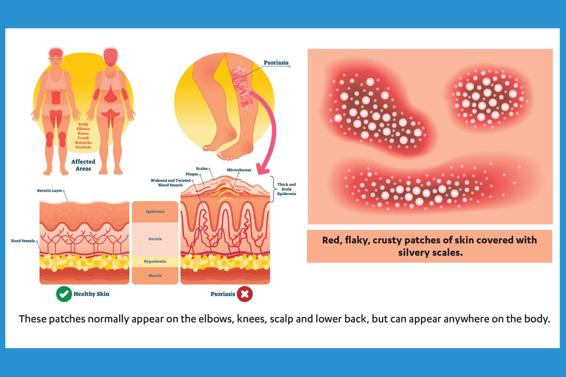 Essential Information for Seniors About Plaque Psoriasis: Causes, Symptoms, and New Treatment Options